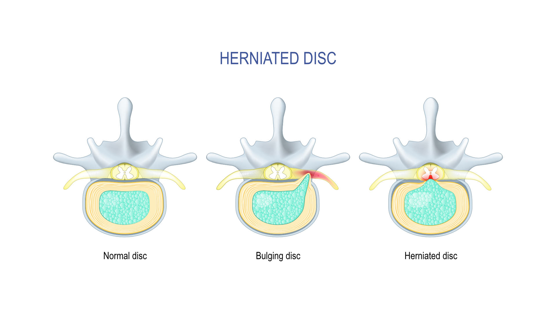 Herniated Disc Treatment in Jacksonville & North Florida