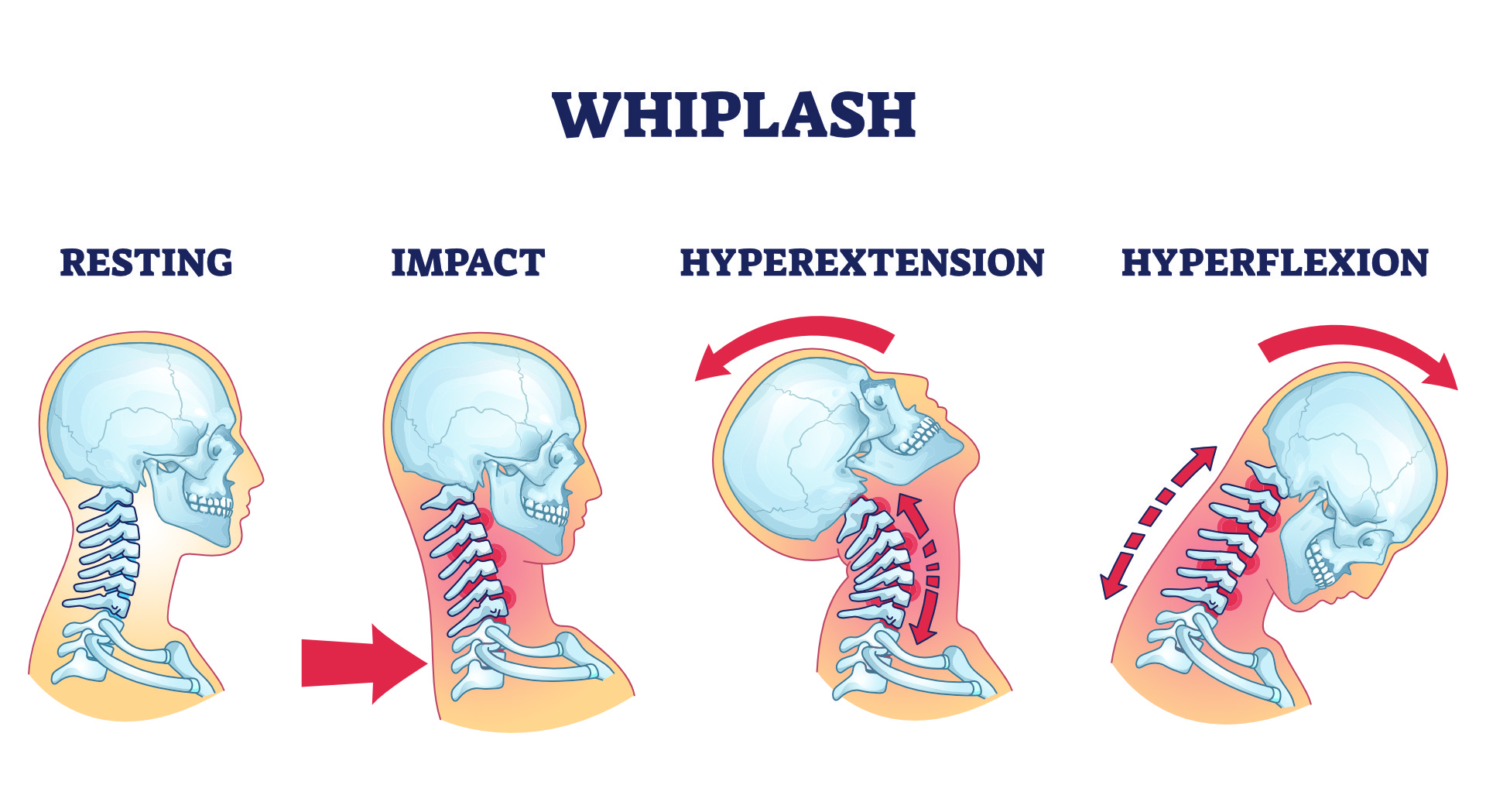 Whiplash Treatment in Jacksonville & North Florida